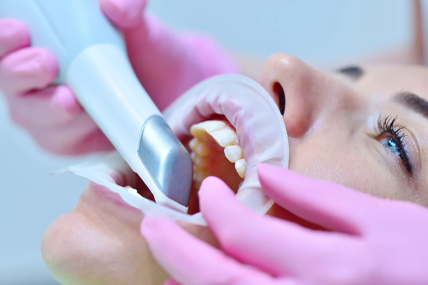 Digitaler Zahnabdruck ohne Würgereiz